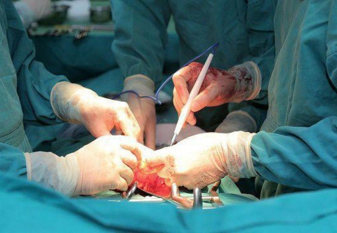 Tại Sao Thoát Vị Đùi Hay Bị Nghẹt Hơn So Với Thoát Vị Bẹn?